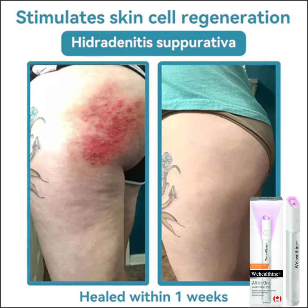 ☂Sparksalezoner® VelvetSkin+Series ⚔️All-in-One Laser Eraser Pen🖊️ (🔬Powered by CO₂ laser technology – effectively removes moles, warts, skin tags, pigmentation spots, and other skin imperfections)