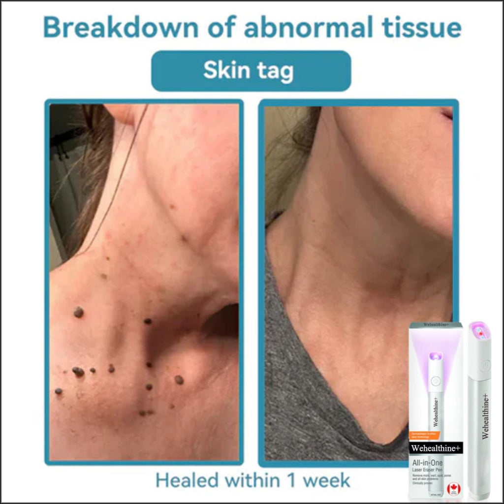 ☂Sparksalezoner® VelvetSkin+Series ⚔️All-in-One Laser Eraser Pen🖊️ (🔬Powered by CO₂ laser technology – effectively removes moles, warts, skin tags, pigmentation spots, and other skin imperfections)