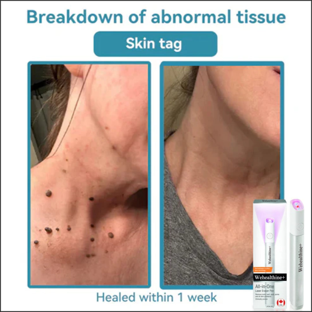 ☂Sparksalezoner® VelvetSkin+Series ⚔️All-in-One Laser Eraser Pen🖊️ (🔬Powered by CO₂ laser technology – effectively removes moles, warts, skin tags, pigmentation spots, and other skin imperfections)