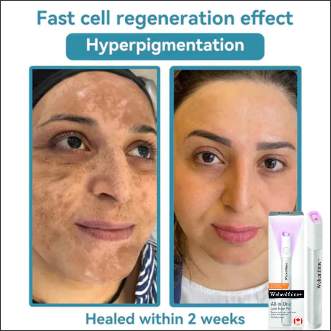 ☂Sparksalezoner® VelvetSkin+Series ⚔️All-in-One Laser Eraser Pen🖊️ (🔬Powered by CO₂ laser technology – effectively removes moles, warts, skin tags, pigmentation spots, and other skin imperfections)
