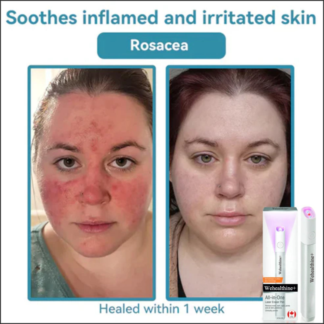 ☂Sparksalezoner® VelvetSkin+Series ⚔️All-in-One Laser Eraser Pen🖊️ (🔬Powered by CO₂ laser technology – effectively removes moles, warts, skin tags, pigmentation spots, and other skin imperfections)