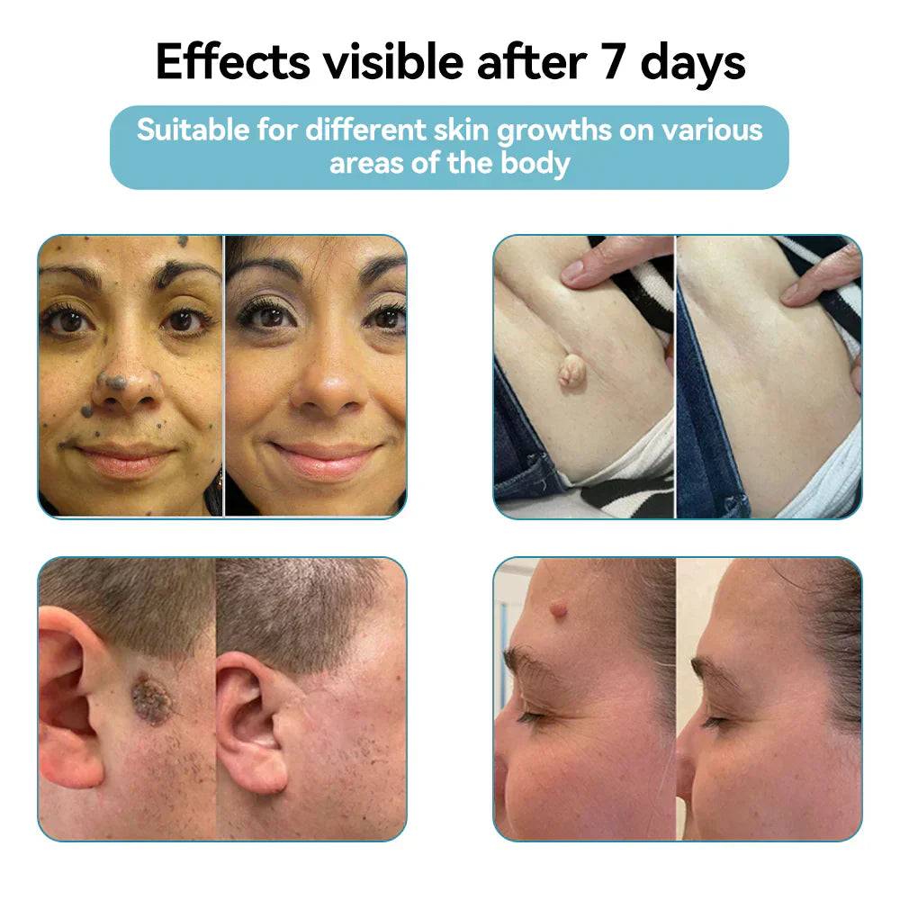 ☂Sparksalezoner® VelvetSkin+Series ⚔️All-in-One Laser Eraser Pen🖊️ (🔬Powered by CO₂ laser technology – effectively removes moles, warts, skin tags, pigmentation spots, and other skin imperfections)