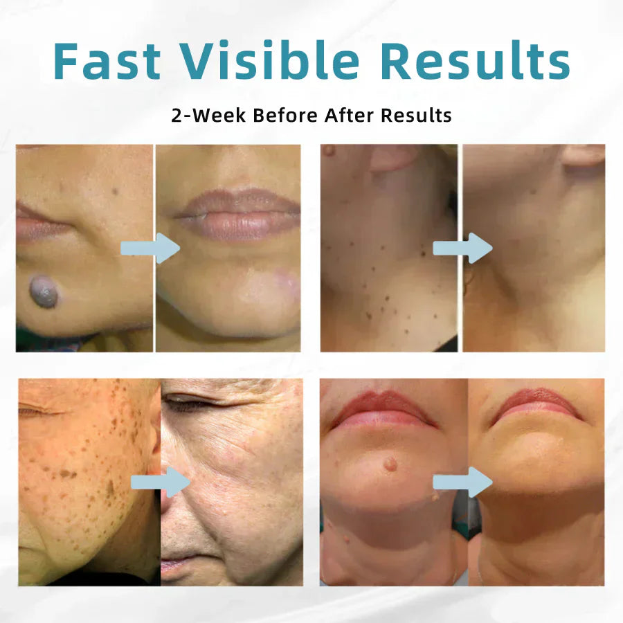 ☂Sparksalezoner® VelvetSkin+Series ⚔️All-in-One Laser Eraser Pen🖊️ (🔬Powered by CO₂ laser technology – effectively removes moles, warts, skin tags, pigmentation spots, and other skin imperfections)