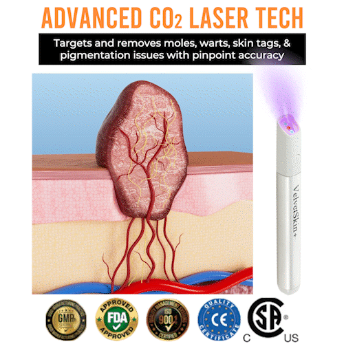 ☂Sparksalezoner® VelvetSkin+Series ⚔️All-in-One Laser Eraser Pen🖊️ (🔬Powered by CO₂ laser technology – effectively removes moles, warts, skin tags, pigmentation spots, and other skin imperfections)